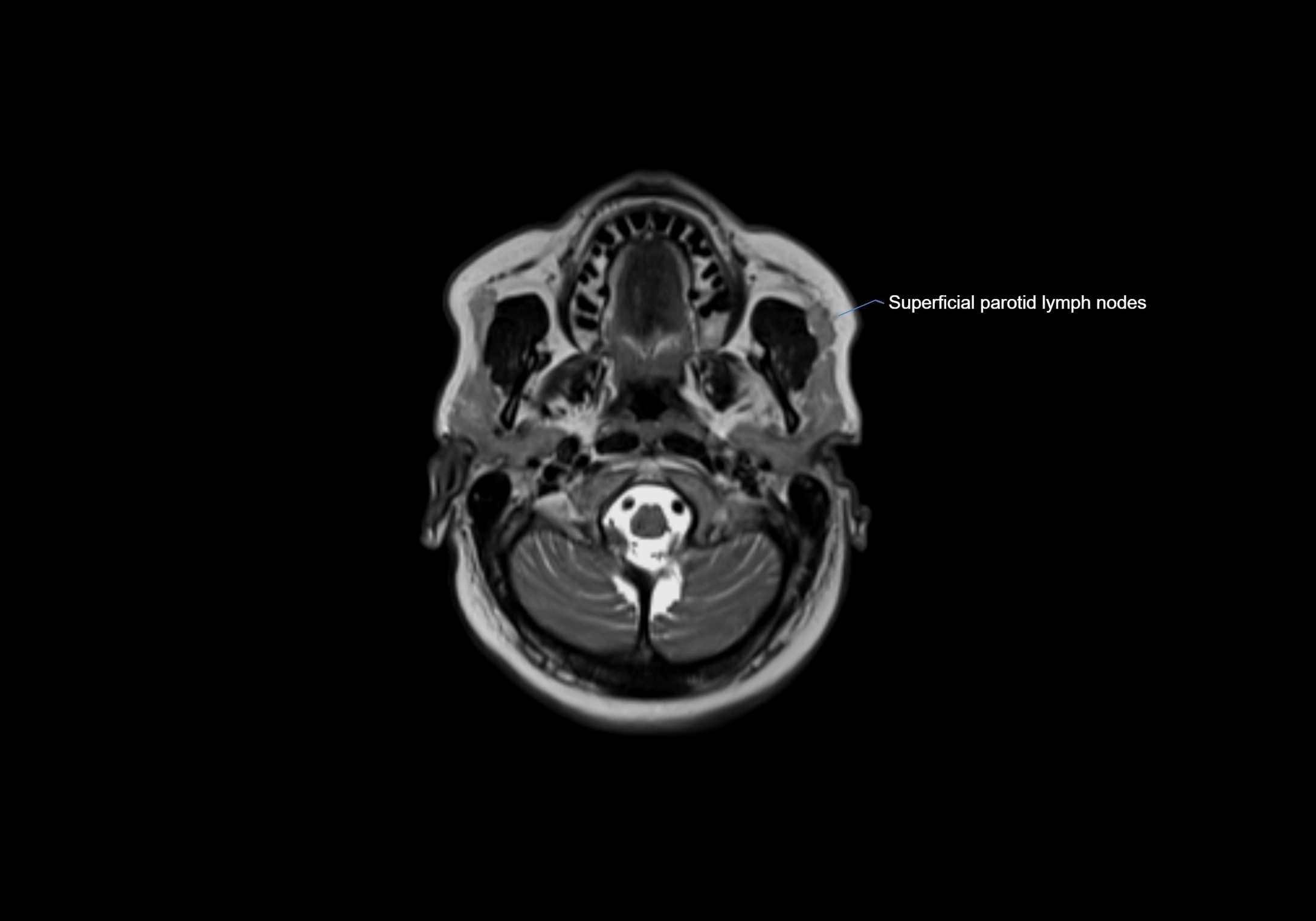 Neck axial  lymph node cross sectional MRI anatomy 3T MRI  image-img-00001-00026.webp